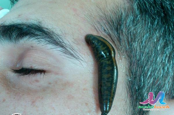 درمان ضعف بینایی با زالو درمانی