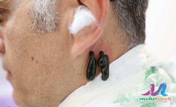 روش استفاده از زالو در درمان آرتروز گردن