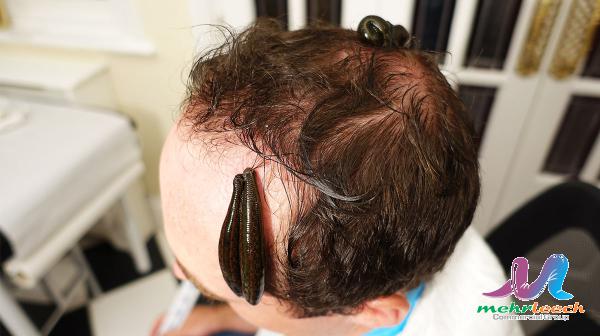 فواید زالو درمانی برای ریزش مو