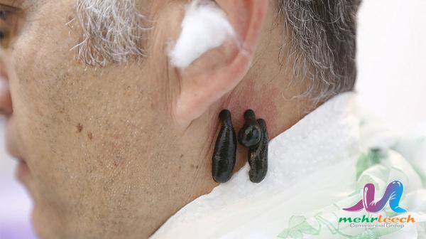 عرضه انواع زالو درمانی  ویژه گوش