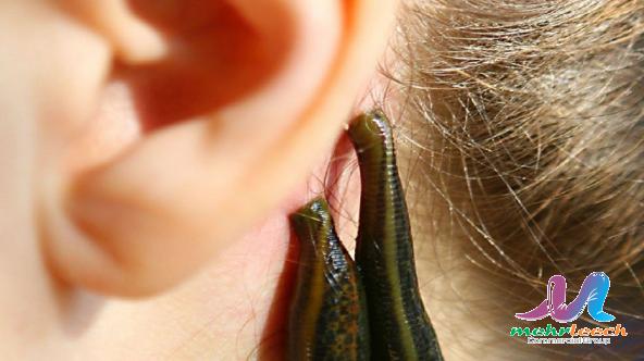 زالو درمانی پشت گوش چه فوایدی دارد؟