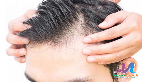 پرورش زالو درمانی مخصوص ریزش مو
